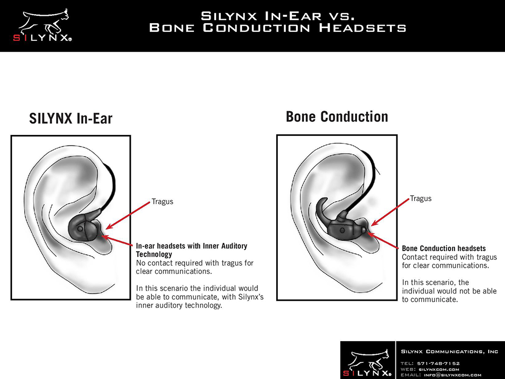 Tecnología In-Ear de Silynx vs conducción ósea